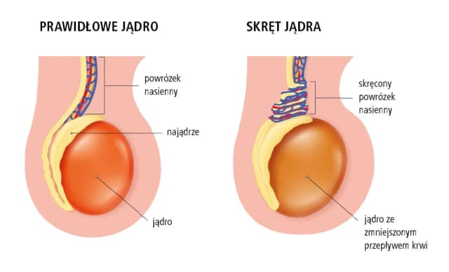 Guz jądra: objawy, które powinny Cię zaniepokoić - nie ignoruj ich Guz jądra: objawy, które powinny Cię zaniepokoić - nie ignoruj ich