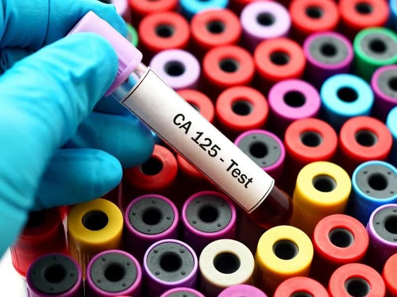 Badanie CA 125: Co to jest i jak pomaga w diagnostyce raka jajnika? Badanie CA 125: Co to jest i jak pomaga w diagnostyce raka jajnika?