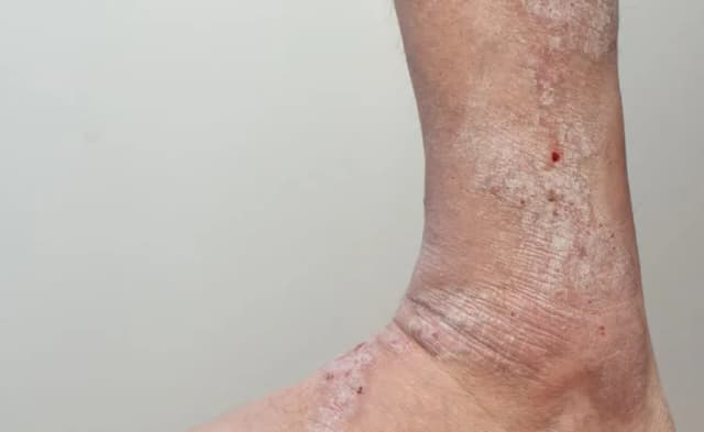 Objawy skórne niewydolności żylnej - 5 oznak, które musisz znać Objawy skórne niewydolności żylnej - 5 oznak, które musisz znać