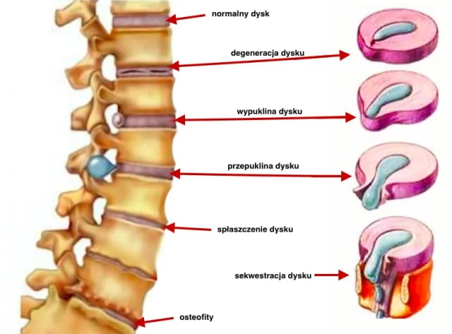 Objawy dyskopatii lędźwiowej: jak rozpoznać i kiedy do lekarza Objawy dyskopatii lędźwiowej: jak rozpoznać i kiedy do lekarza