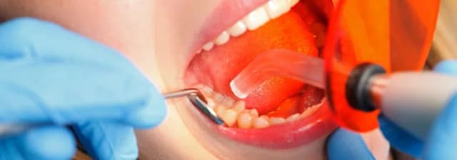 Koszt plomby światłoutwardzalnej na NFZ - co musisz wiedzieć Koszt plomby światłoutwardzalnej na NFZ - co musisz wiedzieć