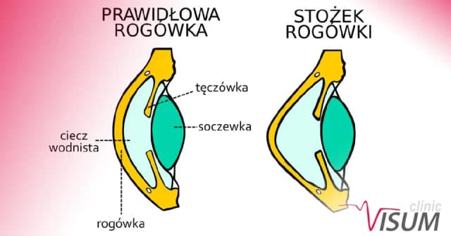 Stożek rogówki: 7 kluczowych objawów, które musisz znać Stożek rogówki: 7 kluczowych objawów, które musisz znać