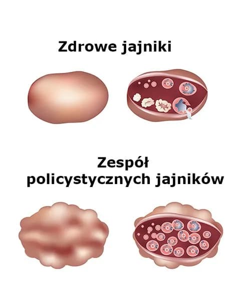 Zespół policystycznych jajników: 7 kluczowych badań - diagnoza Zespół policystycznych jajników: 7 kluczowych badań - diagnoza