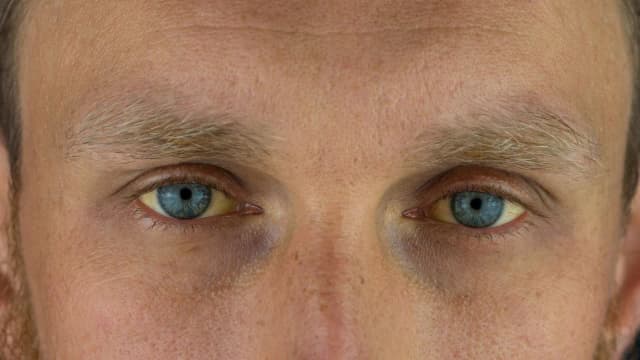 Zespół Gilberta: objawy neurologiczne - co musisz wiedzieć? Zespół Gilberta: objawy neurologiczne - co musisz wiedzieć?