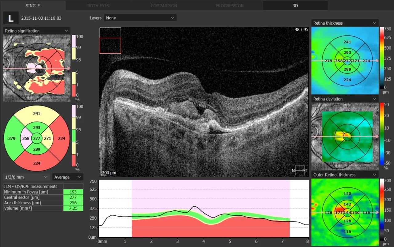 Co wykrywa badanie OCT: 5 kluczowych schorzeń oka Co wykrywa badanie OCT: 5 kluczowych schorzeń oka