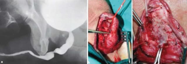 Uszkodzenie cewki moczowej: objawy, przyczyny i powikłania Uszkodzenie cewki moczowej: objawy, przyczyny i powikłania