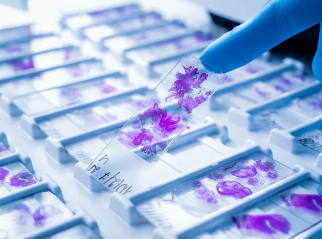 Badanie histopatologiczne: ile się czeka na wyniki i jak przyspieszyć? Badanie histopatologiczne: ile się czeka na wyniki i jak przyspieszyć?