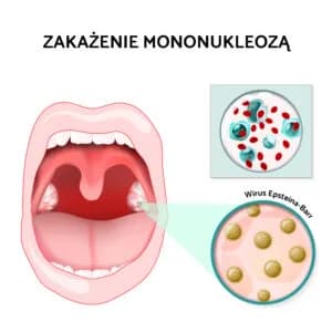 Mononukleoza: jakie badania są kluczowe dla diagnozy? Mononukleoza: jakie badania są kluczowe dla diagnozy?