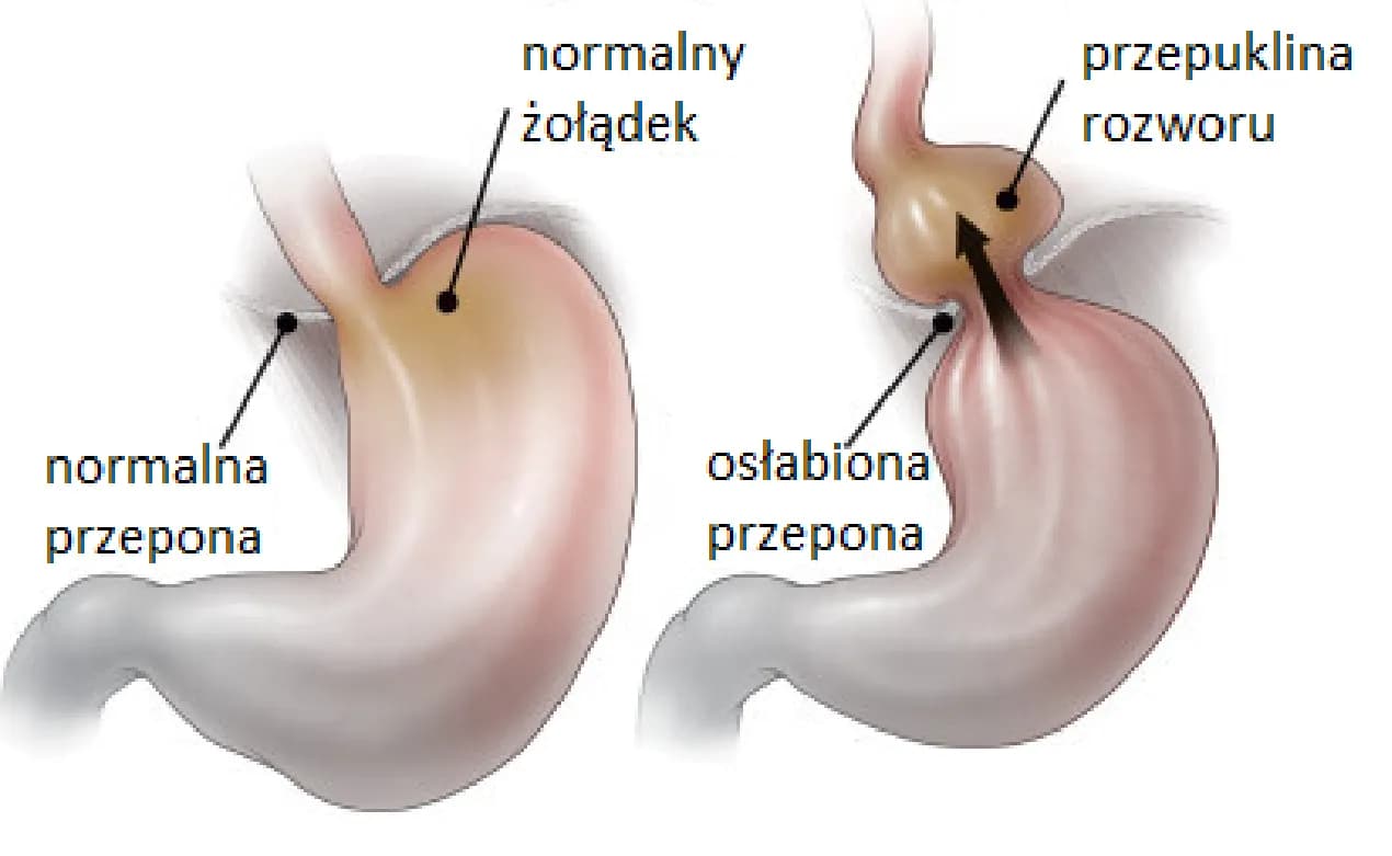 Przepuklina rozworu przełykowego przepony - objawy i zagrożenia Przepuklina rozworu przełykowego przepony - objawy i zagrożenia